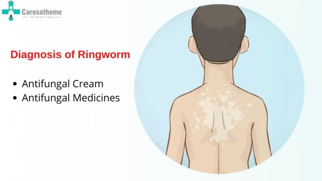 How Ringworm Is Diagnosed and Treated Effectively